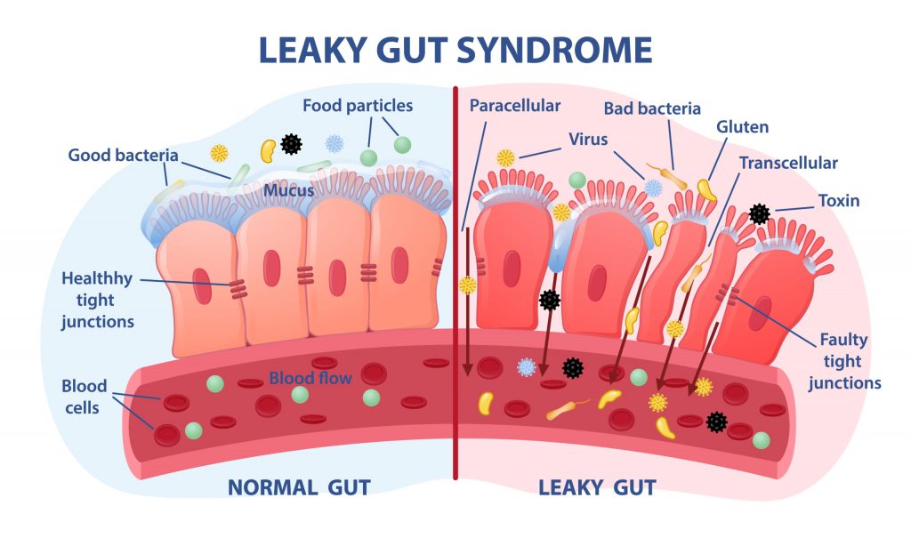 Leaky gut Syndrome concept. Comparison of healthy organ and inflamed tissue cells. Diseases of gastrointestinal tract. Toxins and viruses prosit intestinale